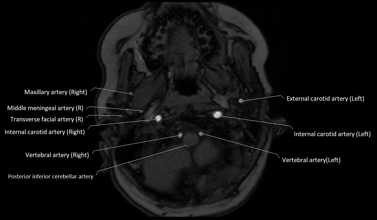 Carotid artery anatomy axial 3T image 4.jpg